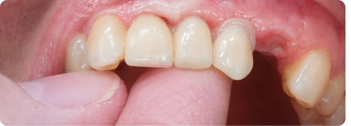 Vizuální postup pro tři sousední zuby v horním oblúku — princip vloženia Denticor můstku s novými zuby a jeho dotvarovania o okolní zuby