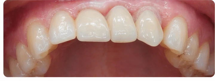 Vizuální postup pro tři sousední zuby v horním oblúku — princip vloženia Denticor můstku s novými zuby a jeho dotvarovania o okolní zuby