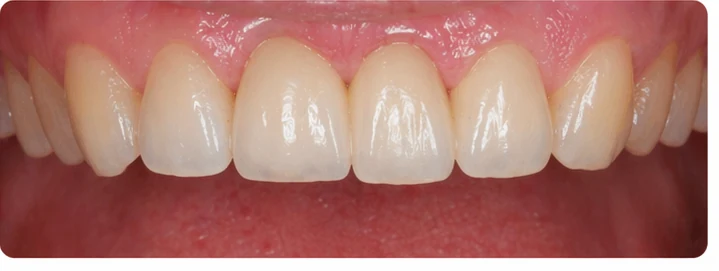 Vizuální postup pro tři sousední zuby v horním oblúku — princip vloženia Denticor můstku s novými zuby a jeho dotvarovania o okolní zuby