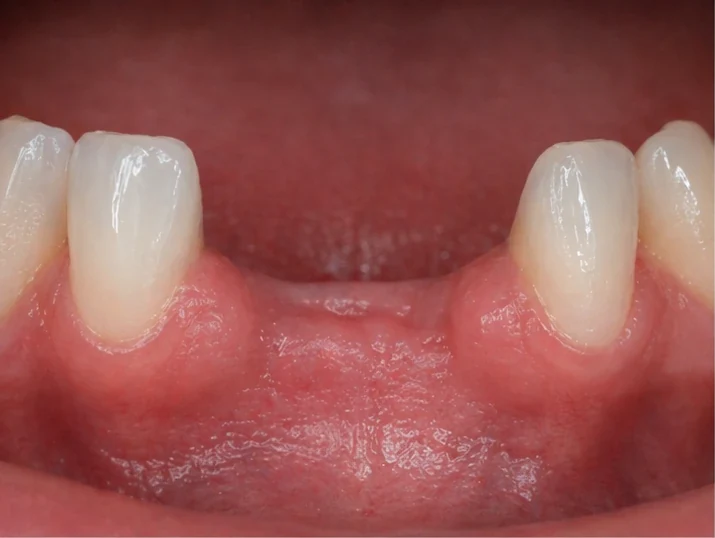 Denticor rychlá náhrada dvou dolních předních rezákov: mezera, připravený DentiFlex můstek s dvěma zuby, vloženie jako celku a výsledek