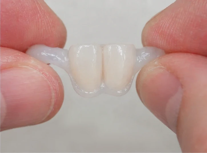 Denticor rychlá náhrada dvou dolních předních rezákov: mezera, připravený DentiFlex můstek s dvěma zuby, vloženie jako celku a výsledek