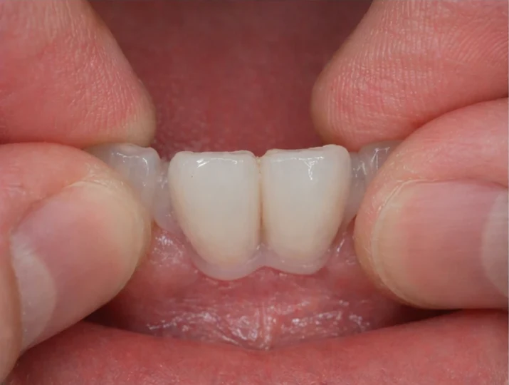 Denticor rychlá náhrada dvou dolních předních rezákov: mezera, připravený DentiFlex můstek s dvěma zuby, vloženie jako celku a výsledek