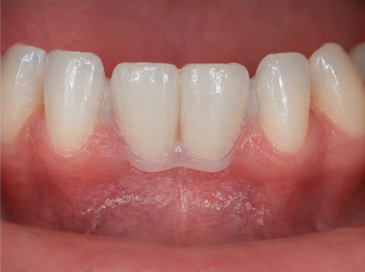 Denticor rychlá náhrada dvou dolních předních rezákov: mezera, připravený DentiFlex můstek s dvěma zuby, vloženie jako celku a výsledek