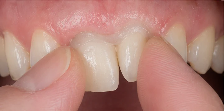 Vizuální postup vloženia a dotvarovania náhrady — dolní boční rezák