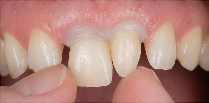 Vizuální návod — chybějící dva dolní premoláre