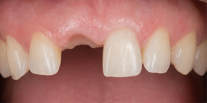 Vizuální postup vloženia a dotvarovania náhrady — dolní premolár