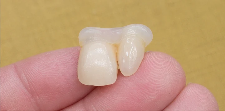 Vizuální postup vloženia a dotvarovania náhrady — dolní premolár