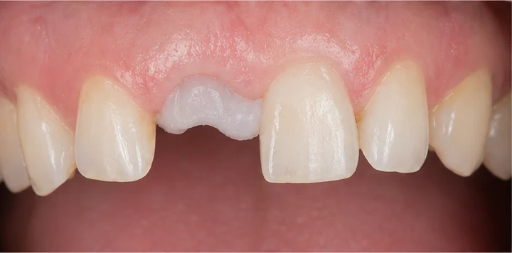 Vizuální postup vloženia a dotvarovania náhrady — dolní premolár