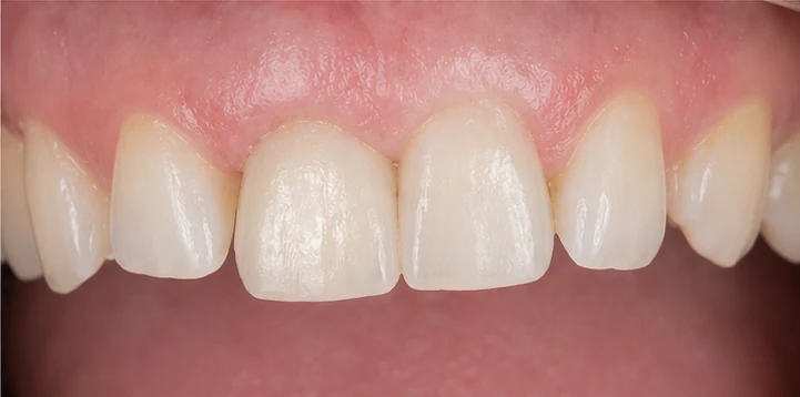 Vizuální postup vloženia a dotvarovania náhrady — dolní premolár