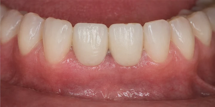 Vizuální postup vloženia a dotvarovania náhrady — dolní rezák a oční zub