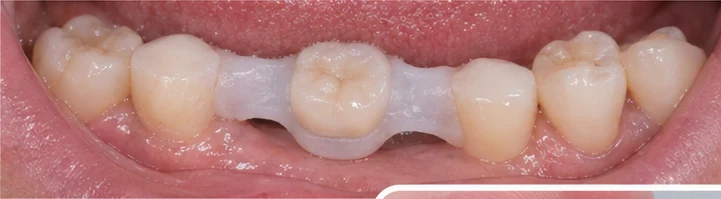 Vizuální postup vloženia a dotvarovania náhrady — dolní rezák a oční zub