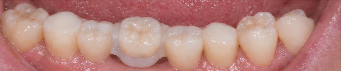 Vizuální postup vloženia a dotvarovania náhrady — dolní rezák a oční zub