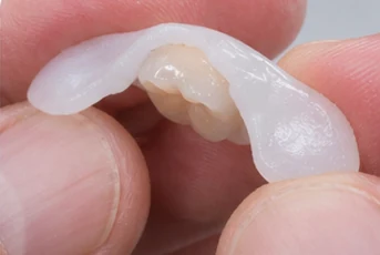 Vizuální postup vloženia a dotvarovania náhrady — dolní rezák a oční zub