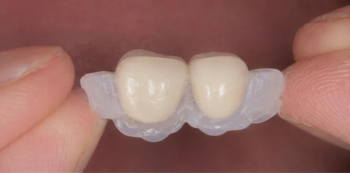 Vizuální postup vloženia a dotvarovania náhrady — hornú stoličku se sousedem