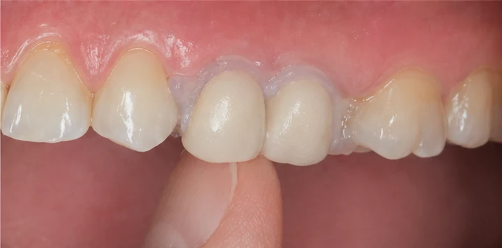 Vizuální postup vloženia a dotvarovania náhrady — hornú stoličku se sousedem