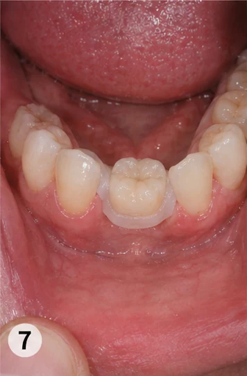 Vizuální postup vloženia a dotvarovania náhrady — hornú stoličku se sousedem