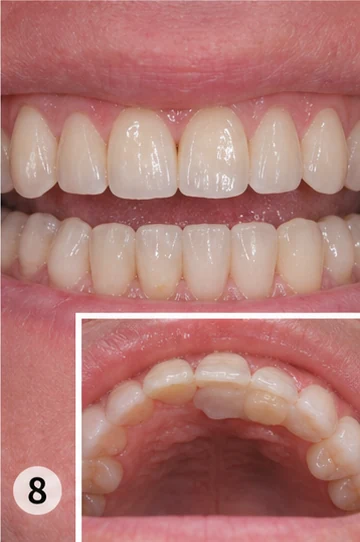 Vizuální postup vloženia a dotvarovania náhrady — hornú stoličku se sousedem