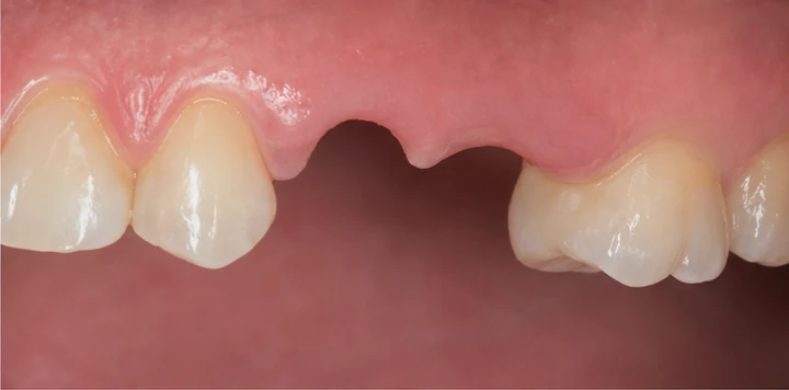 Vizuální postup vloženia a dotvarovania náhrady — horní dva premoláre