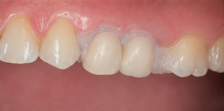 Vizuální postup vloženia a dotvarovania náhrady — horní dva premoláre