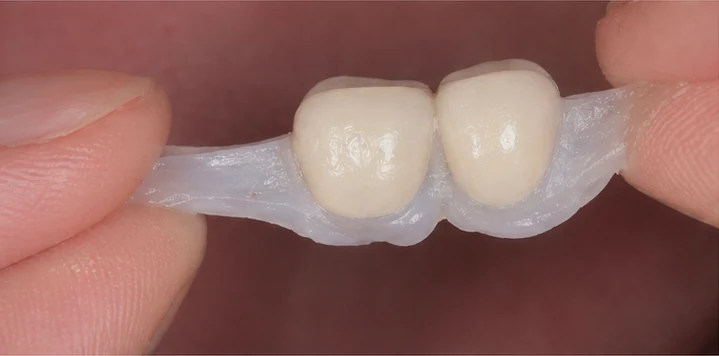 Vizuální postup vloženia a dotvarovania náhrady — horní dva střední rezáky