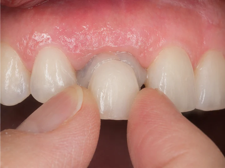 Vizuální postup vloženia a dotvarovania náhrady — horní boční rezák