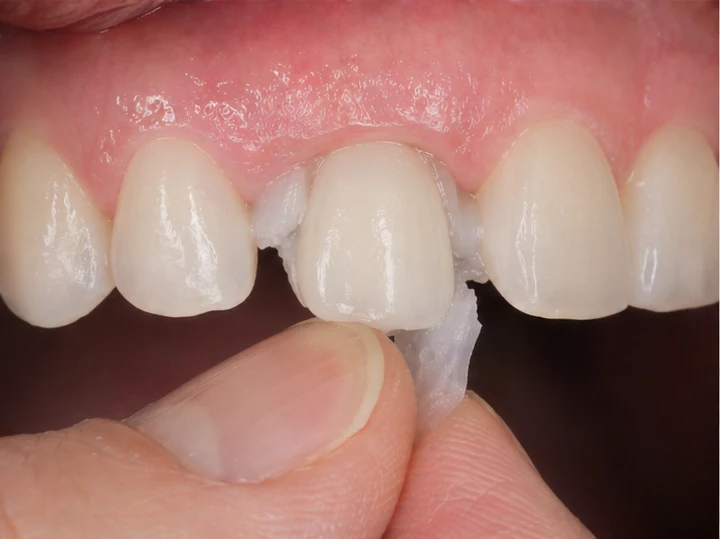 Vizuální návod — chybějící horní oční zub a premolár