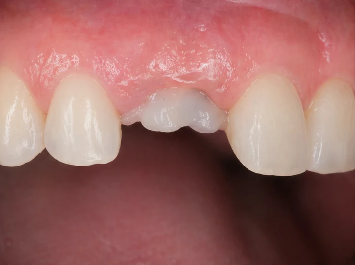 Vizuální návod — chybějící horní oční zub a premolár