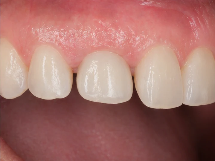 Vizuální postup vloženia a dotvarovania náhrady — horní premolár