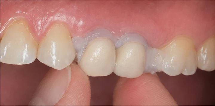 Vizuální návod — chybějící dva horní premoláre