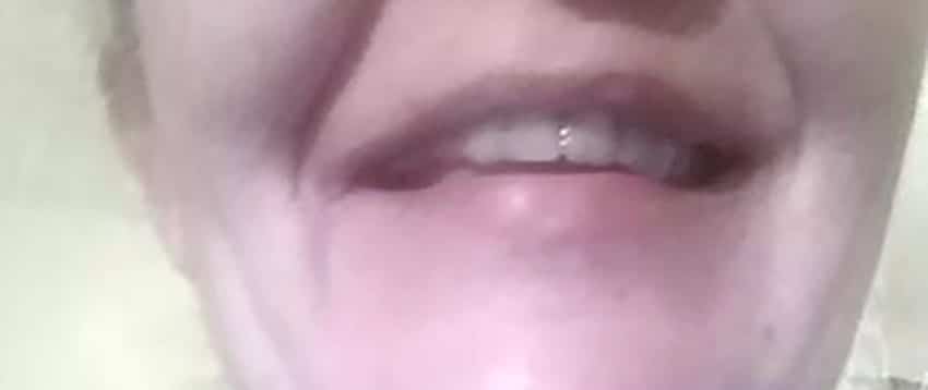 Zákazníčka — přední zub doplnený Denticorom