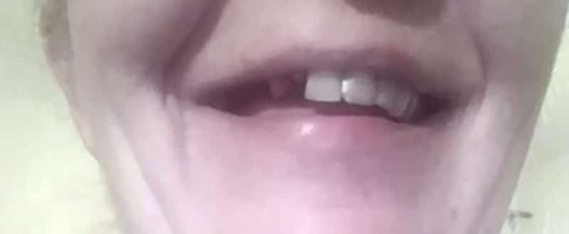 Zákazníčka — zlomený přední zub, před nasazením Denticoru