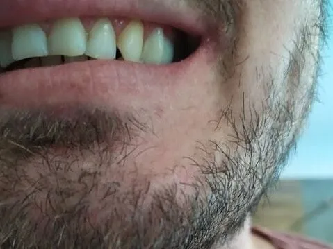 Zákazník — zub doplnený, boční pohled