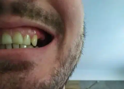 Zákazník — chybějící zub, boční pohled