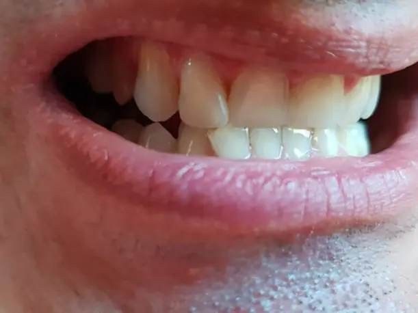 Zákazníčka — horní zub opravený Denticorom