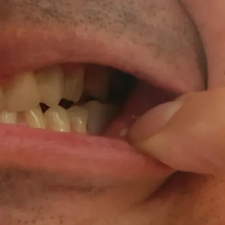 Zákazník — dolní zub doplnený Denticorom