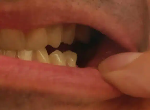 Zákazník — chybějící dolní zub