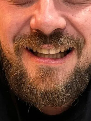 Zákazník — přední zuby doplnené Denticorom