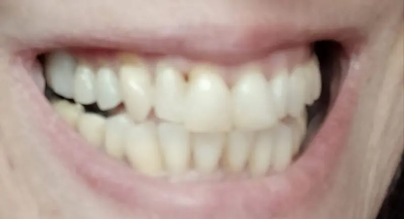 Zákazníčka — mezera zakrytá Denticorom