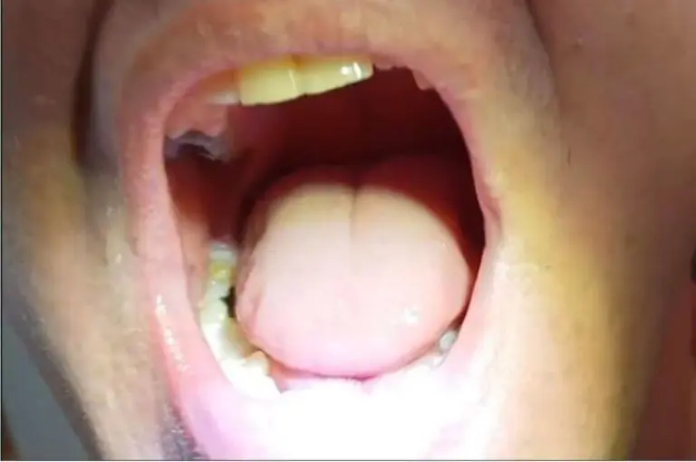 Zákazníčka — boční zub doplnený Denticorom