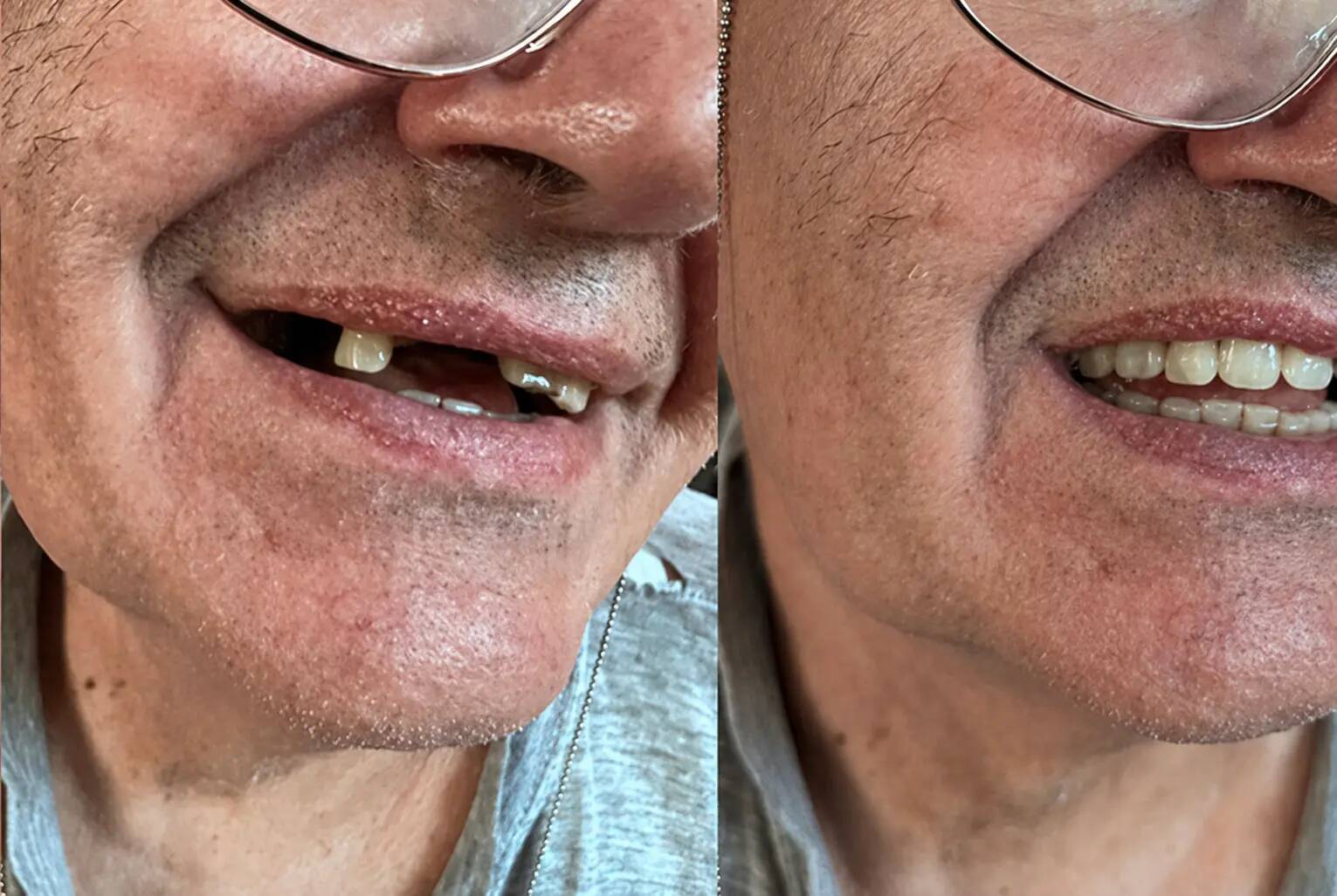 Zákazník — více chybějících zubů před a po Denticor